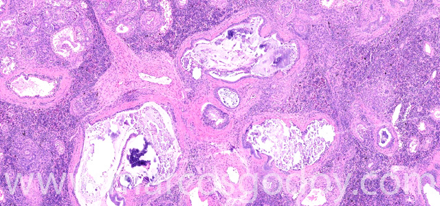 Calcinosis renal X