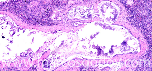 Calcinosis renal XI
