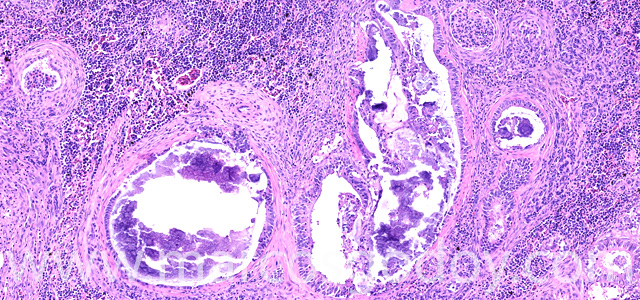 Calcinosis renal XII