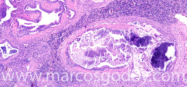 Calcinosis renal XIII