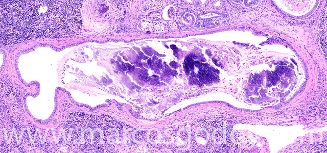 calcinosis renal I