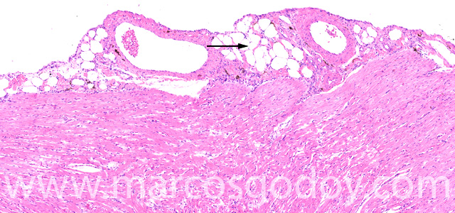 Epicardial fat I
