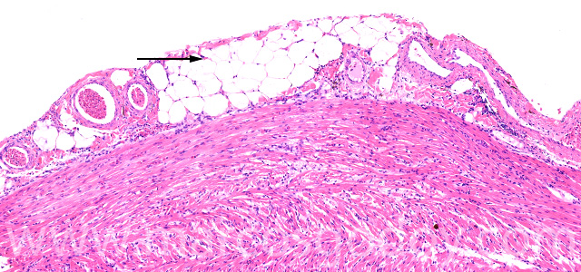 Epicardial fat V