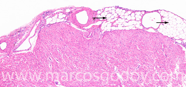 Epicardial fat VII