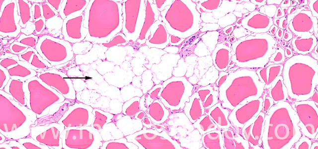 Muscle esteatosis I