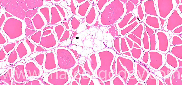 Muscle esteatosis II
