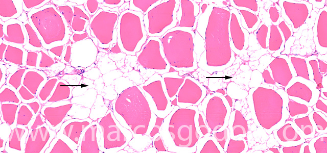 Muscle esteatosis III