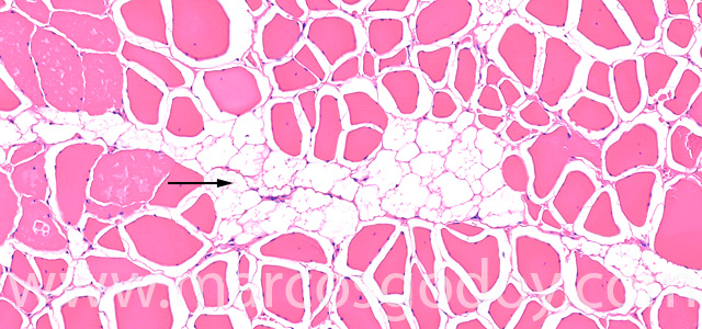 Muscle esteatosis IV