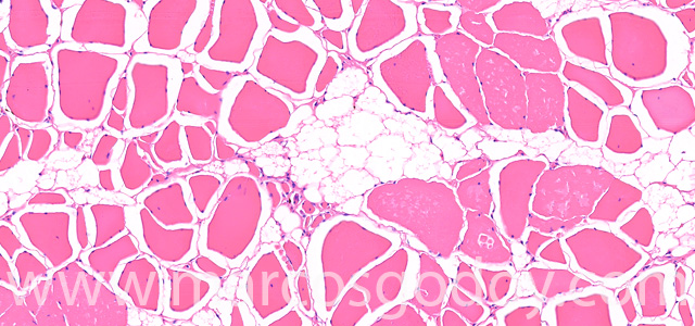 Muscle esteatosis V