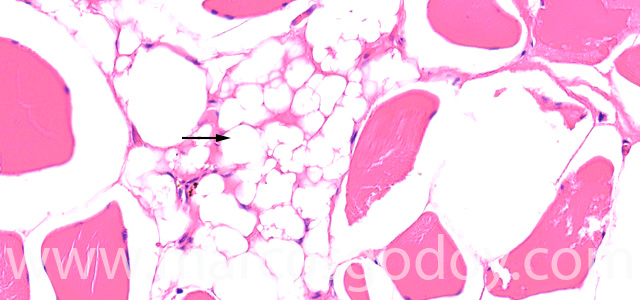 Muscle esteatosis VI