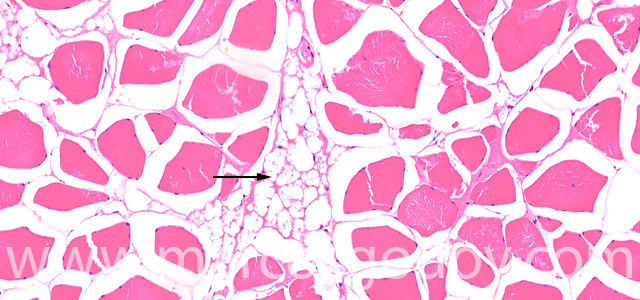 Muscle esteatosis VII