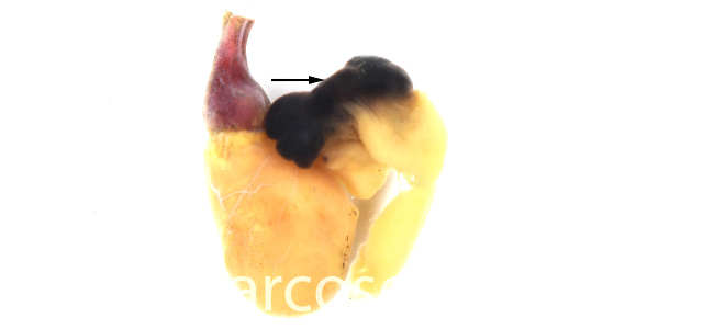 Auricular rupture gross