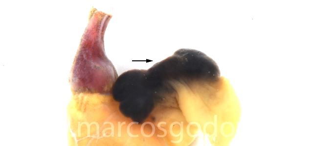 Auricular rupture gross II