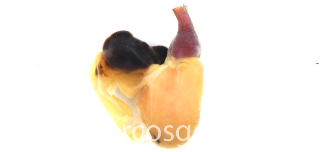 Auricular rupture gross III
