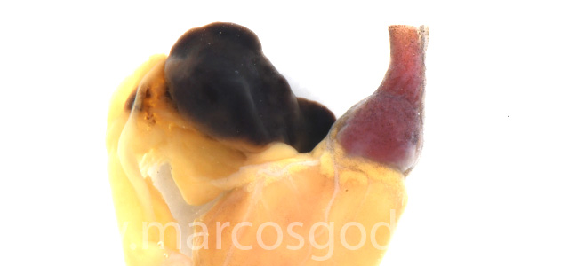 Auricular rupture gross IV