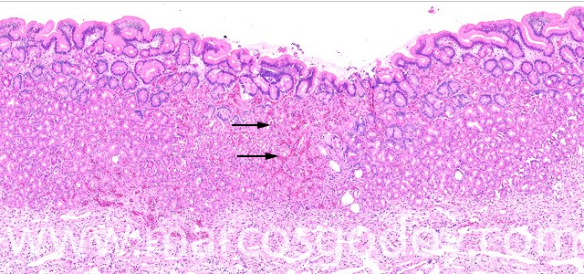 Erosive gastritis I