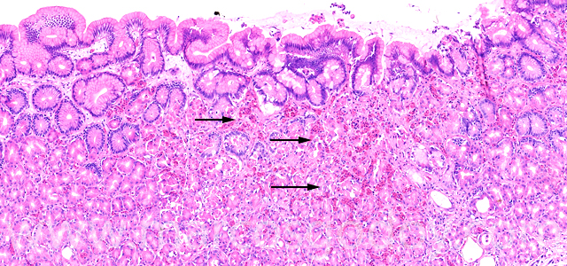 Erosive gastritis II