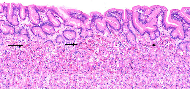 Erosive gastritis V