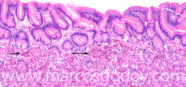 Erosive gastritis VI