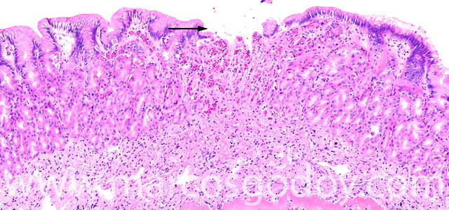 Erosive gastritis VII