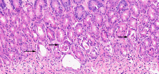 Gastric gland necrosis III