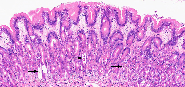 Gastric gland necrosis IX