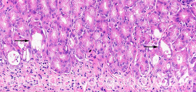 Gastric gland necrosis V