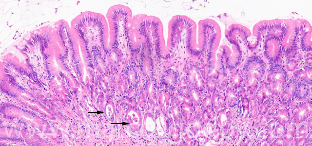Gastric gland necrosis VII
