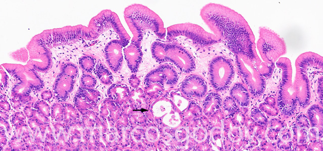 Gastric gland necrosis XIII