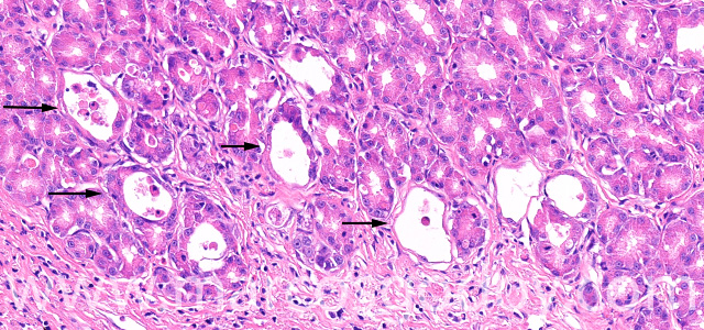 Gastric gland necrosis XIV