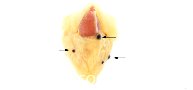 Aneurisma cardiaco II