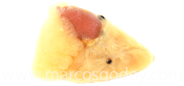 Aneurisma cardiaco V