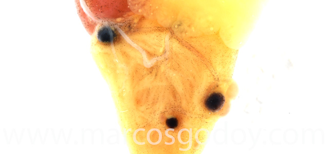 Aneurisma cardiaco VII