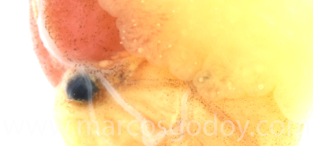 Aneurisma cardiaco X