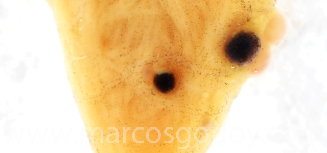 Aneurisma cardiaco XI