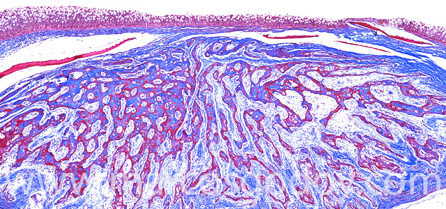 Heterotopic osification IV