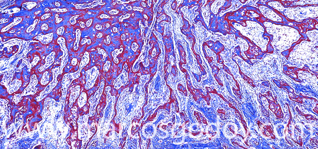 Heterotopic osification V