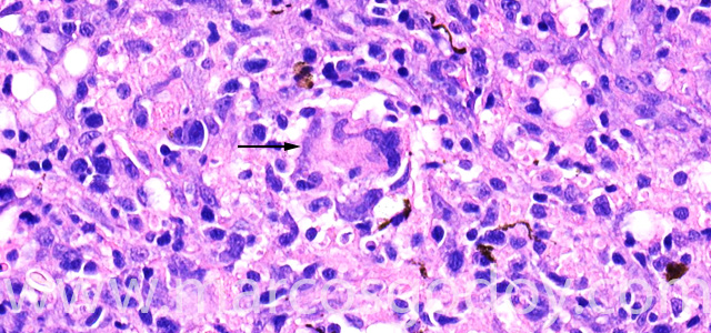 Giant cell III