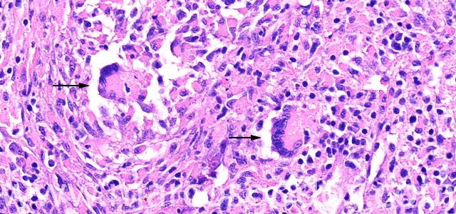 Giant cell IVjpg