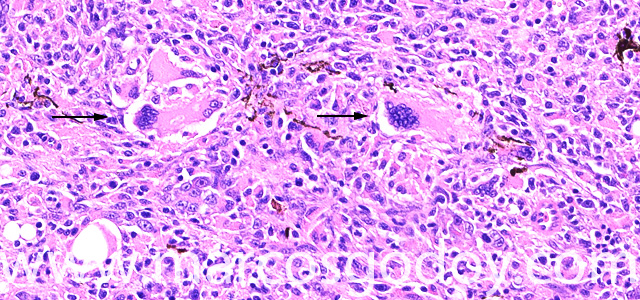 Giant cell VII