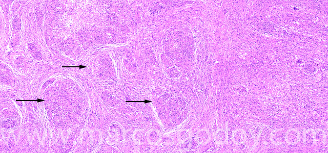 Granulomatous hepatitis I