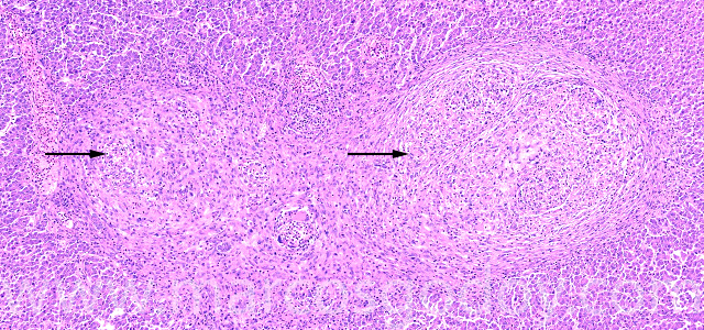 Granulomatous hepatitis II