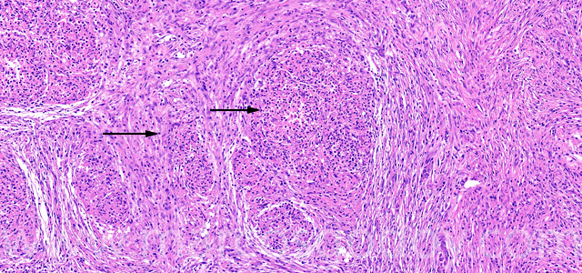Granulomatous hepatitis III