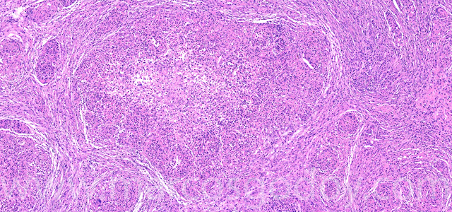 Granulomatous hepatitis IV
