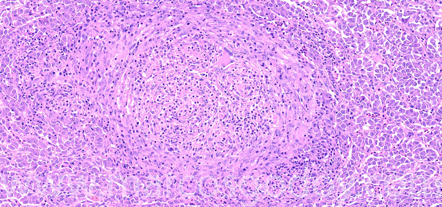 Granulomatous hepatitis V
