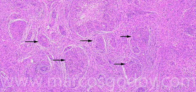 Granulomatous hepatitis VII