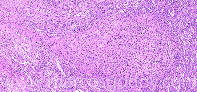 Granulomatous hepatitis VIII