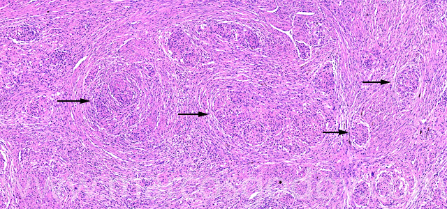 Granulomatous hepatitis X