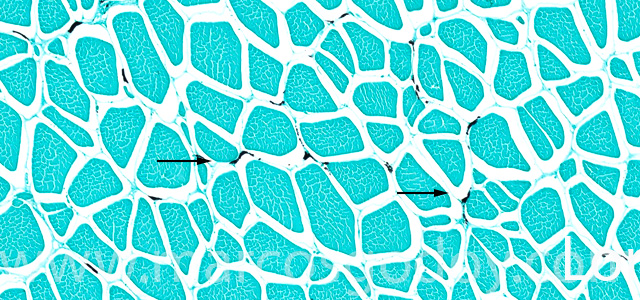 Melnosis Fontana III
