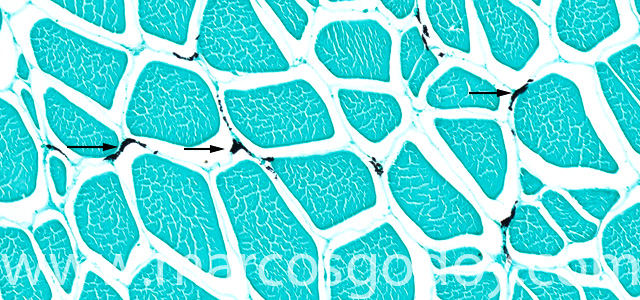 Melnosis Fontana V